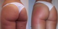 /album/galleria-lipo-us/lipo-us-jpg/